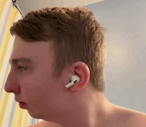 Όταν η διπλή επέμβαση γνάθου δεν αλλάζει απλώς πρόσωπο – αλλάζει ζωή