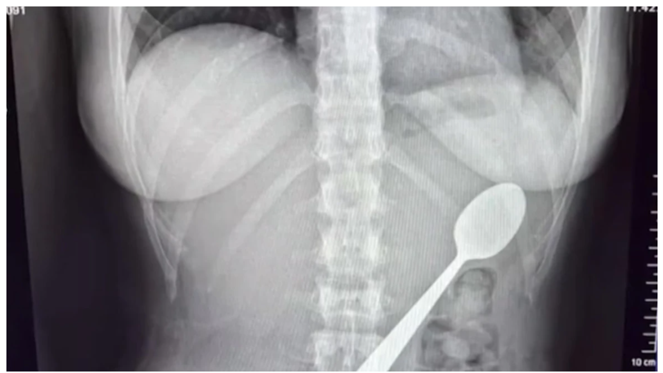 Βέλγιο: 28χρονη κατάπιε κουτάλι 17 εκατοστών – Πήδηξε πάνω της ο σκύλος της (Βίντεο)